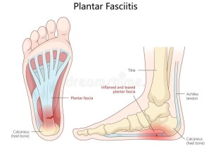 anatomical-diagram-plantar-fasciitis-showing-inflammation-tearing-plantar-fascia-heel-pain-foot-structure-370038757
